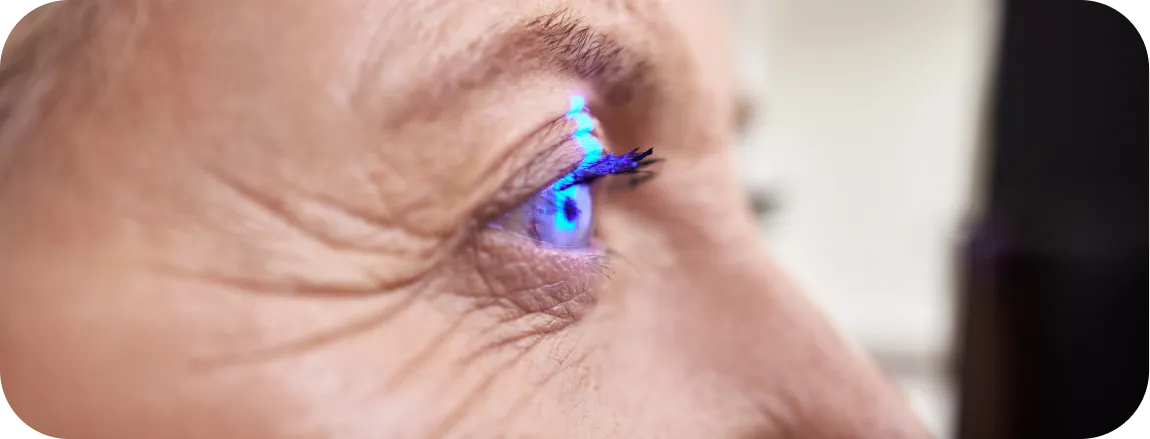 Argon Laser