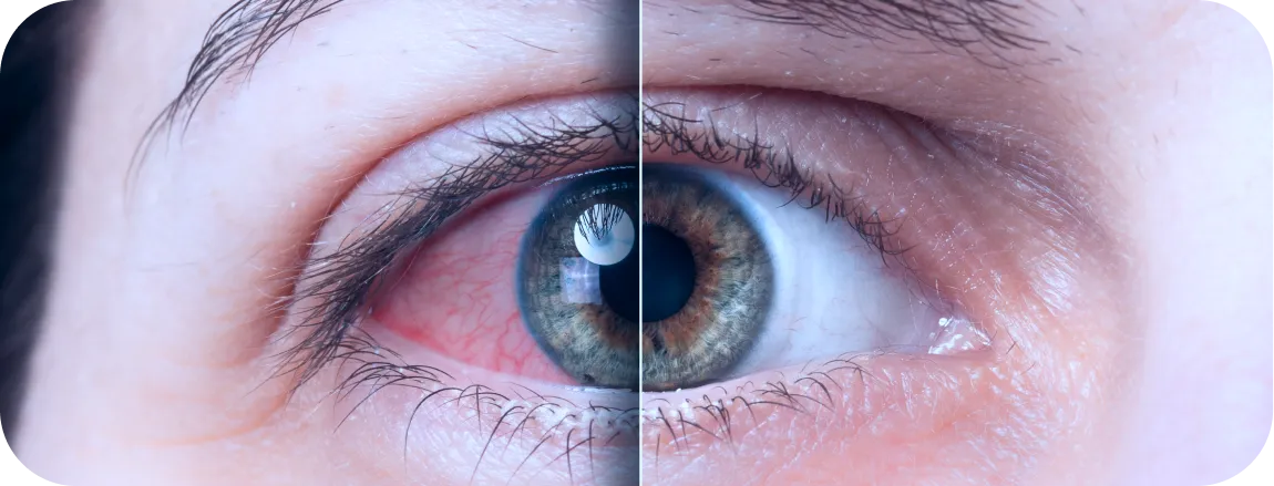 Glaucoma