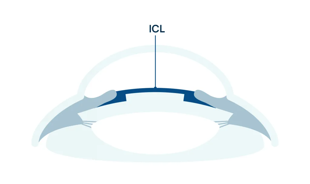 Icl
