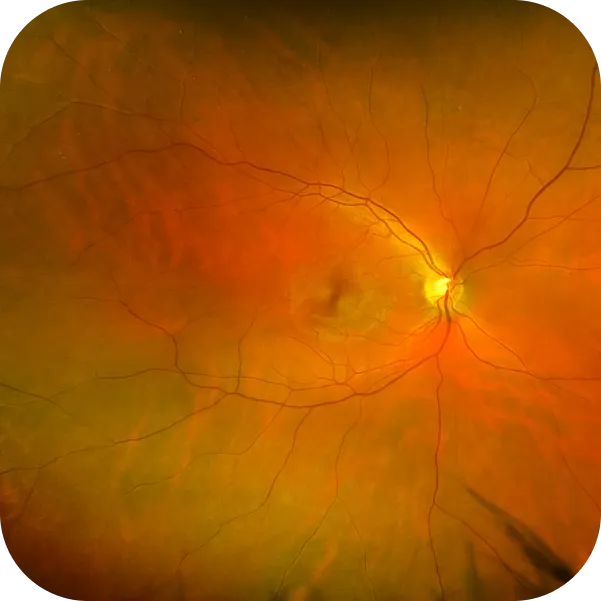 Retinografia esame