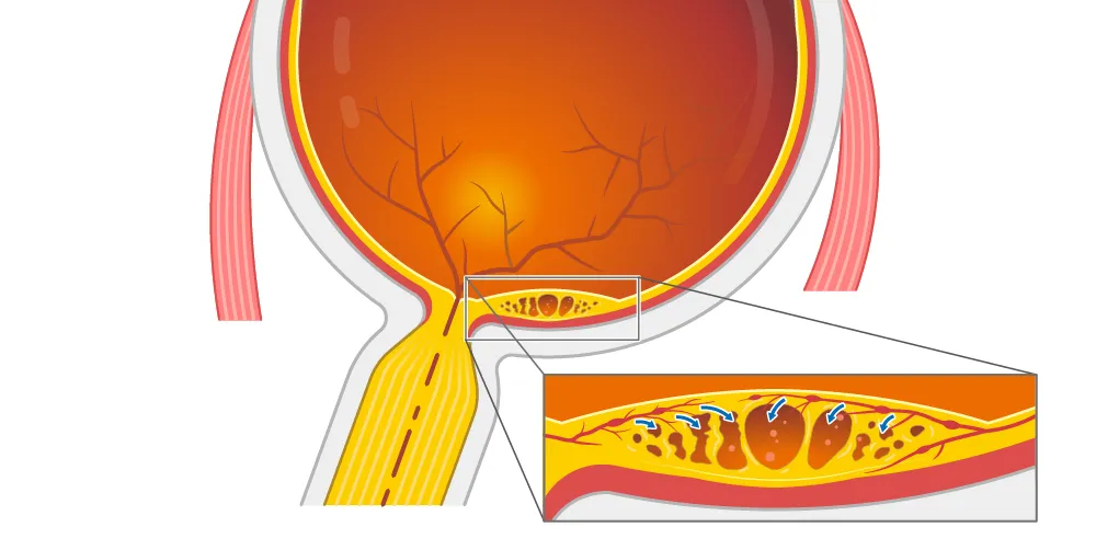 Retinopatia diabetica grafico