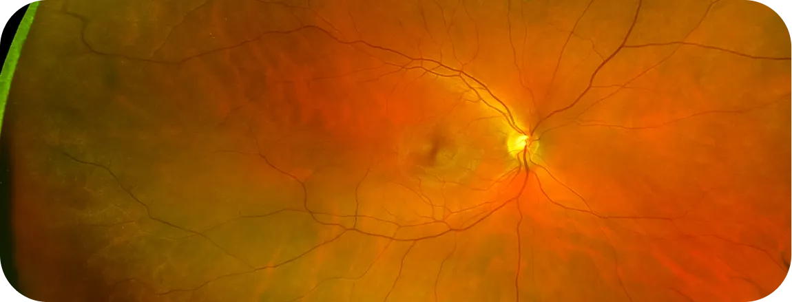 Distacco di retina