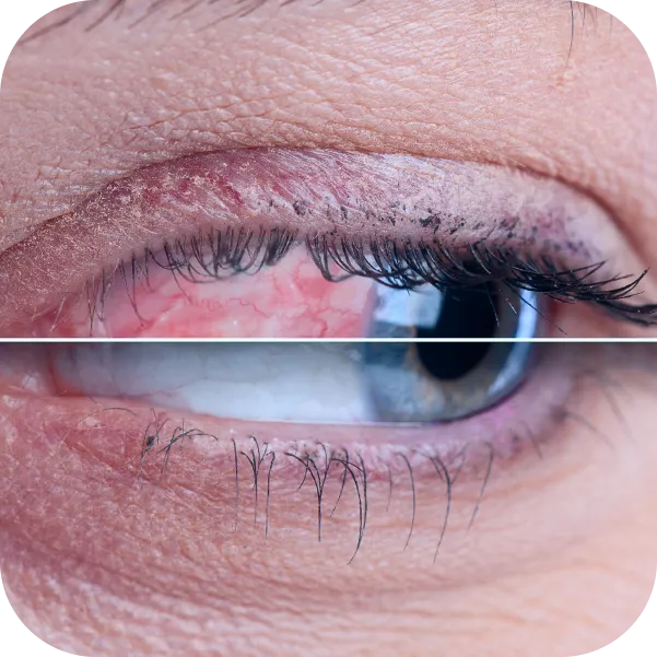 Trattamento della sindrome dellocchio secco dry eye come funziona