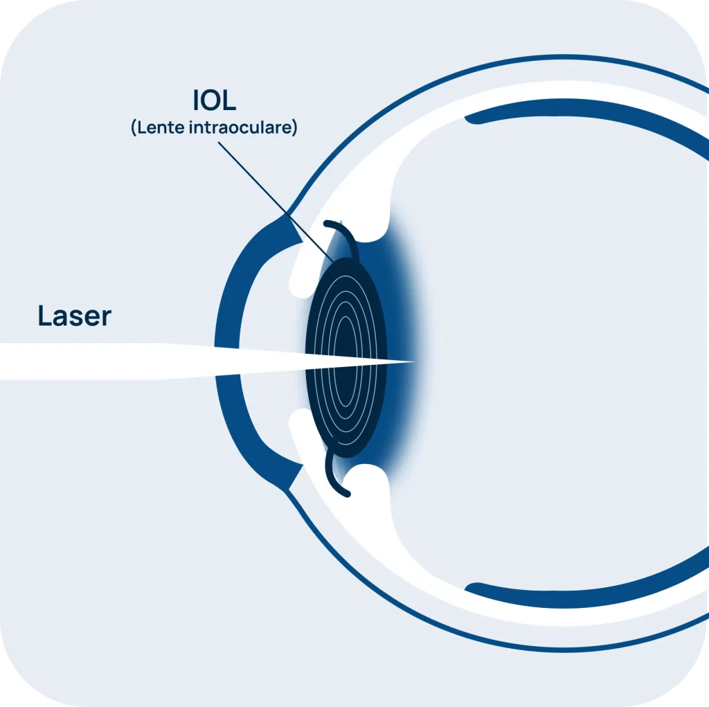 Yag laser cataratta