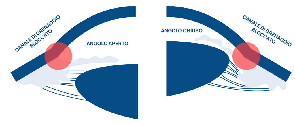Glaucoma infografica