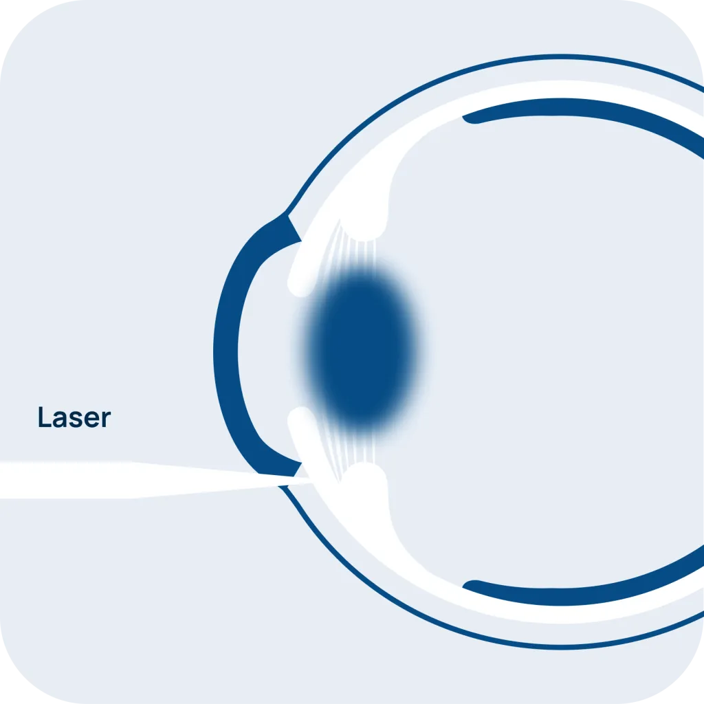 Laser glaucoma