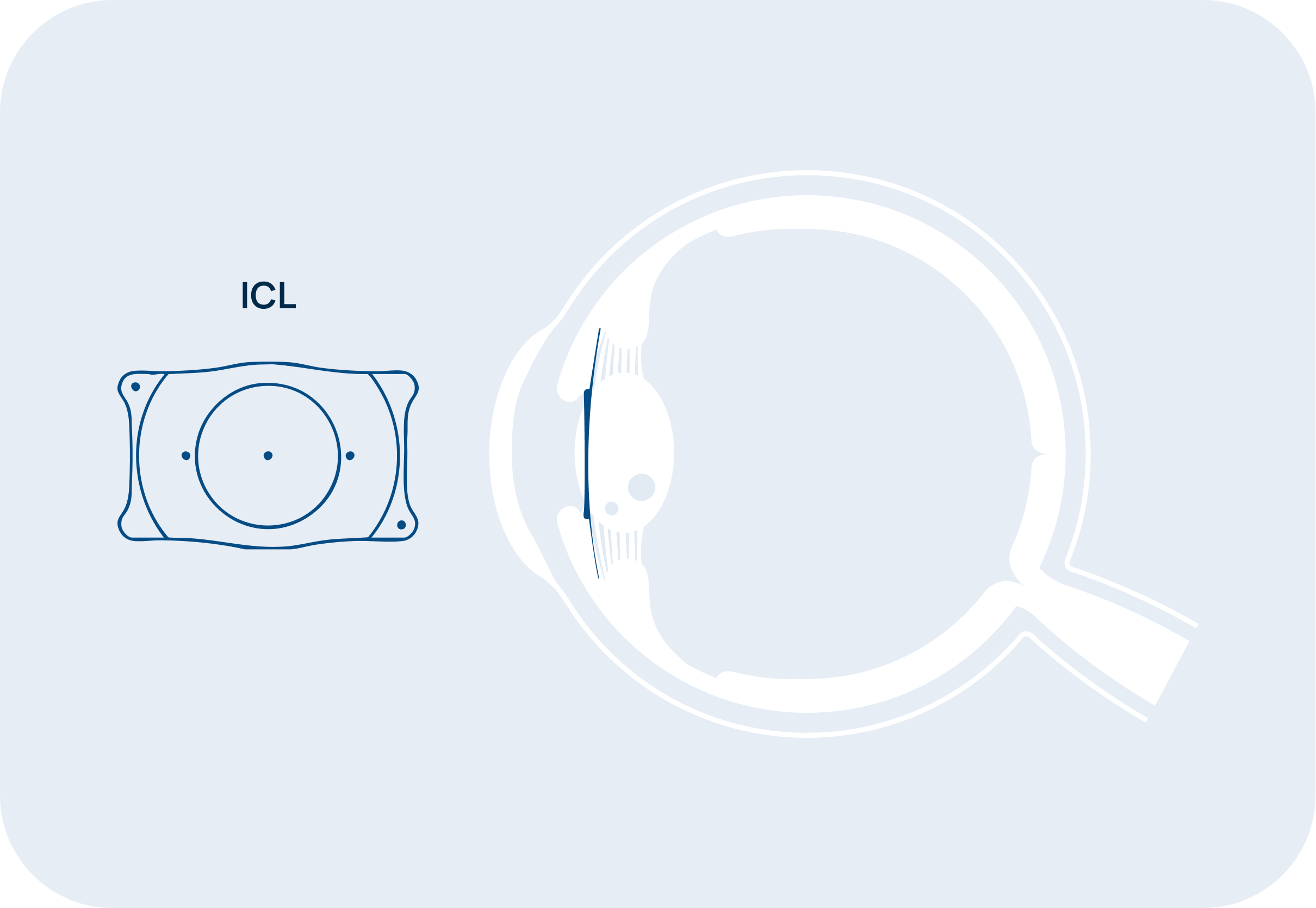 Schema dell’occhio con la lente ICL posizionata tra l’iride e il cristallino