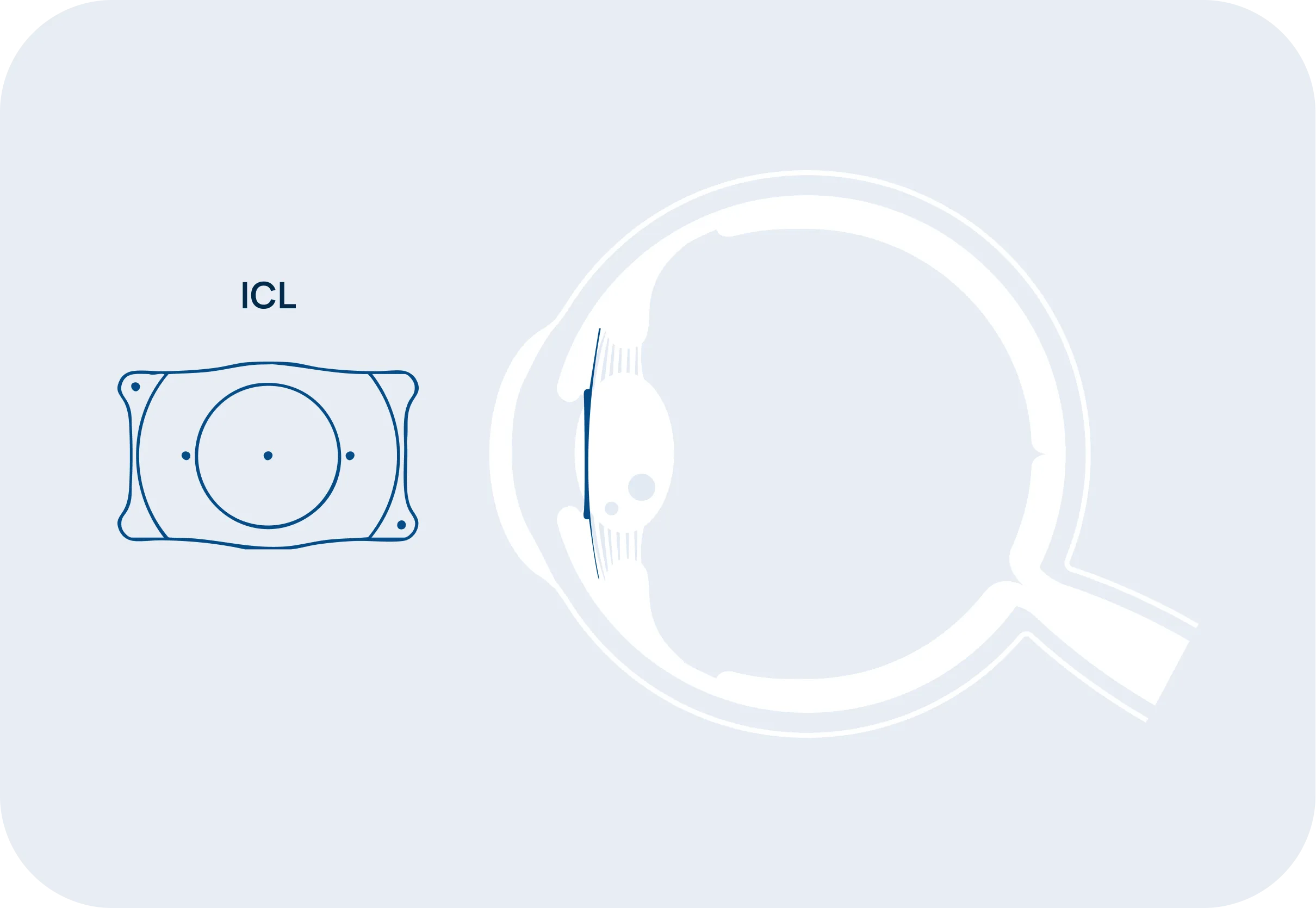 Occhio lente fachica icl 2