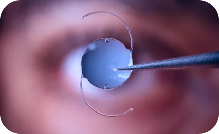 Ocular lens iol