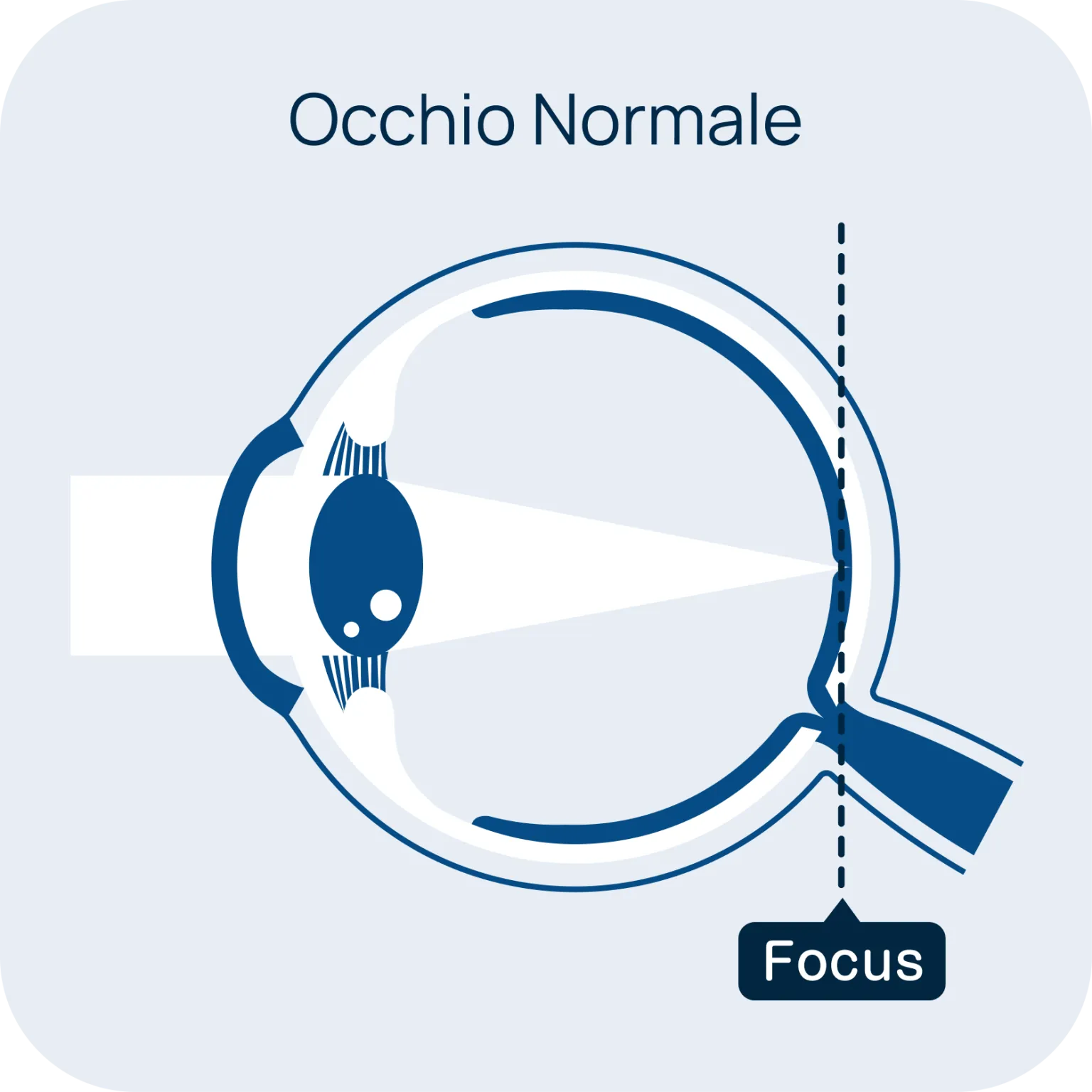 Occhio normale