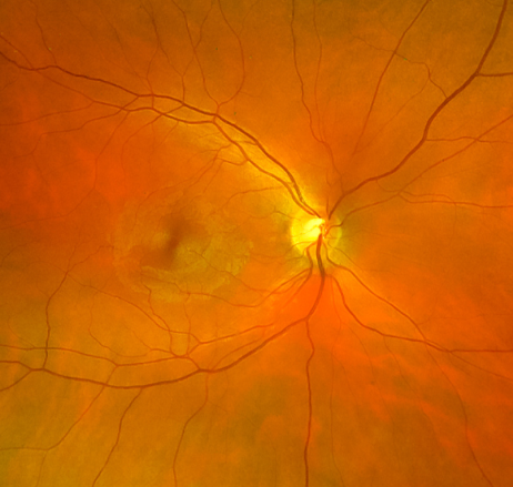 Immagine del fondo oculare con retina, nervo ottico e vasi sanguigni