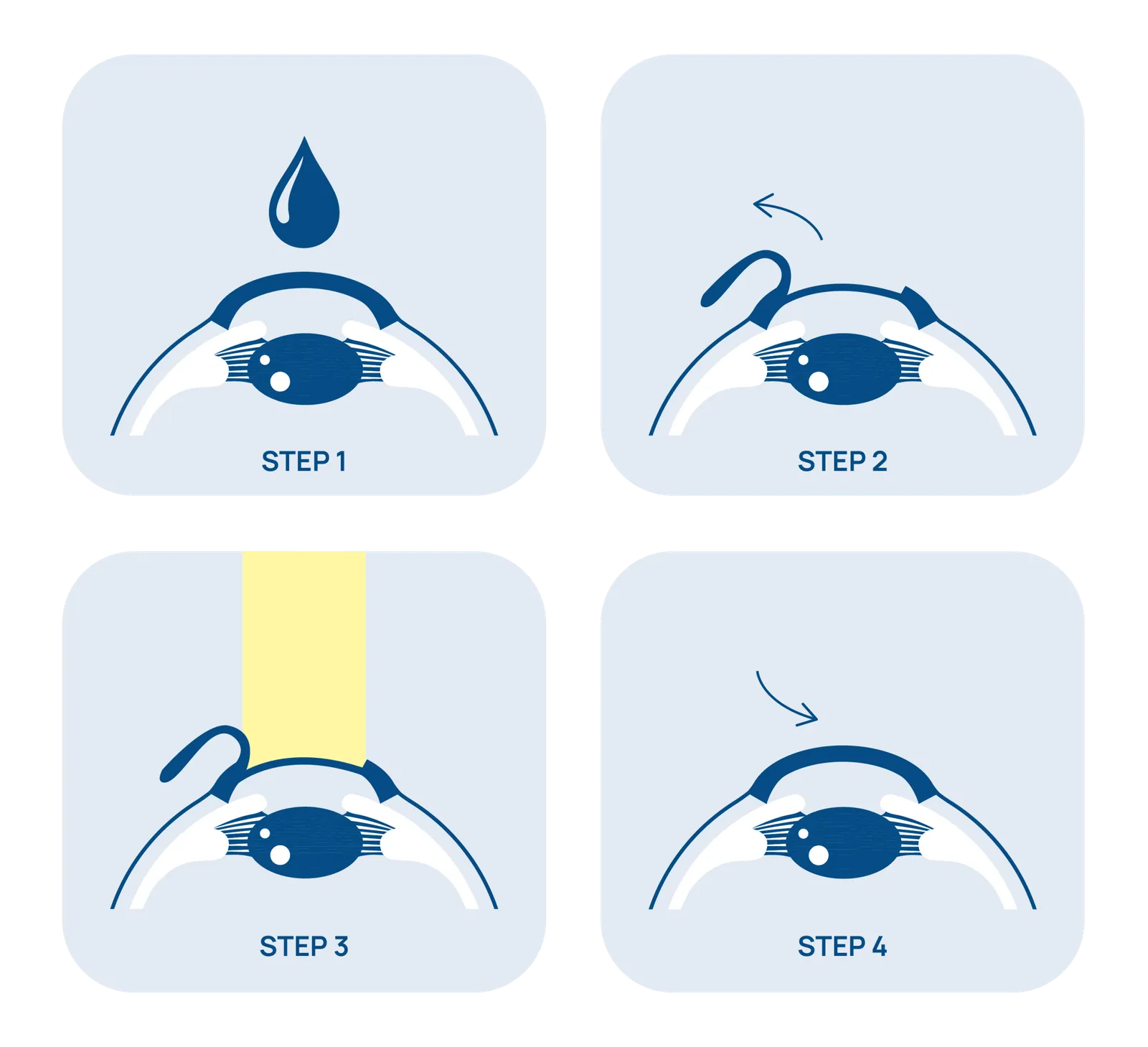 Le 4 fasi dell'intervento Femto-LASIK: anestesia, creazione del flap, laser, riposizionamento