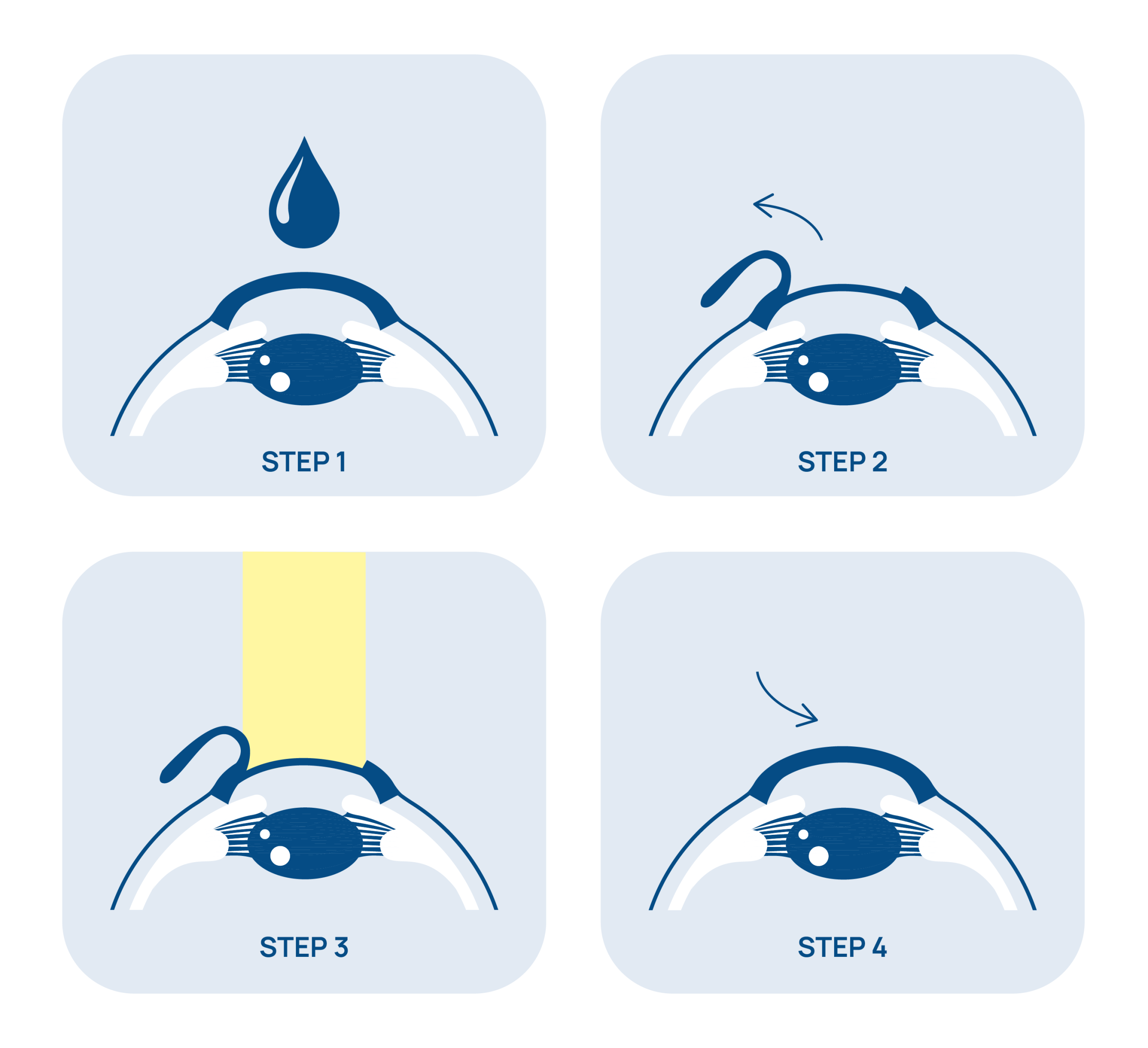 Schema dell'intervento Femto-LASIK — Chirurgia refrattiva Edoria Vision